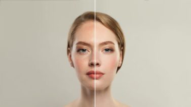 жирна шкіра