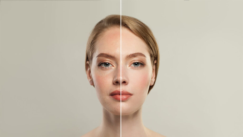 Жирна шкіра обличчя: причини, догляд та рекомендації жирна шкіра